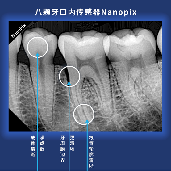 NanoPix 将根管轮廓和牙周膜边界都开到HD高清模式